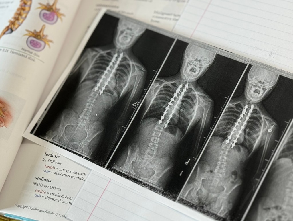 Idiopathic scoliosis